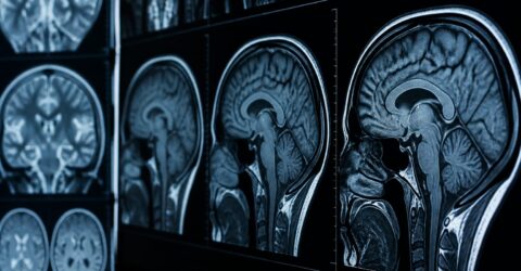 Poți influența riscul de demență chiar dacă ai deja markeri de risc mai ridicat. Ce spune un studiu urmărit 15 ani