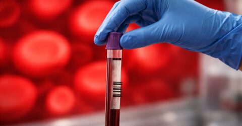 Două teste de sânge pentru Alzheimer, aprobate în S.U.A., pot ghida medicul mai rapid