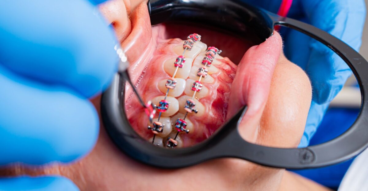 Aparat dentar fix cu sprijin de până la 5.000 de lei pentru elevii din București. Ce pași ai de urmat