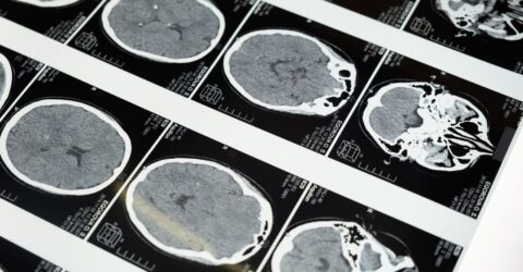 AVC-ul ischemic se tratează în primele șase ore. Ce spune medicul despre cazurile până la 24 de ore
