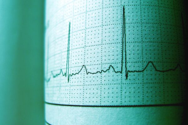 Pulsul mic în repaus nu înseamnă mereu risc mai mic de AVC. Cea mai mică rată a fost la 60-69 de bătăi pe minut